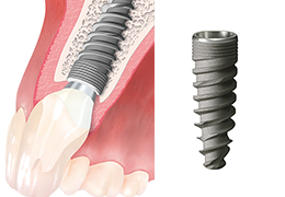 インプラント