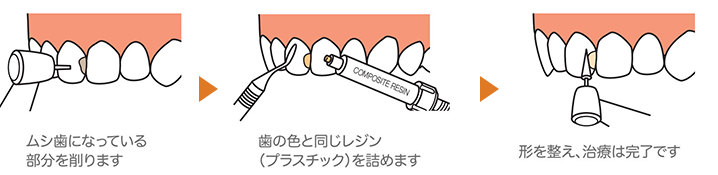 前歯のむし歯（C1,C2）や奥歯の小さいむし歯には詰め物（レジン充填）を行います