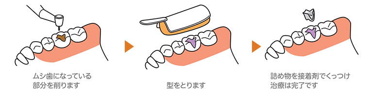 奥歯の大きなむし歯には詰め物（インレー）を作ります