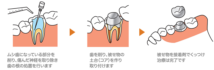 神経まで達した前歯や奥歯のむし歯（C3）には被せ物（クラウン）を作ります