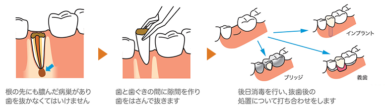 根だけを残して進行したむし歯（残根）には抜歯を行います