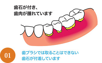 歯周病治療の流れ