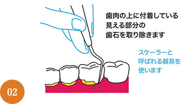 歯周病治療の流れ