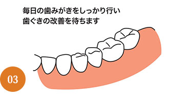 歯周病治療の流れ