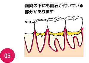 まだ歯肉に炎症がみられる部分には、次の歯周治療に進みます