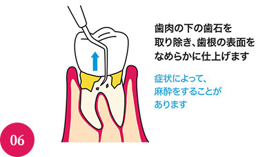 まだ歯肉に炎症がみられる部分には、次の歯周治療に進みます