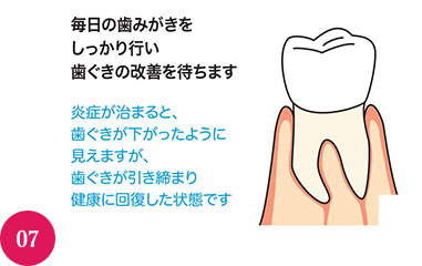 まだ歯肉に炎症がみられる部分には、次の歯周治療に進みます