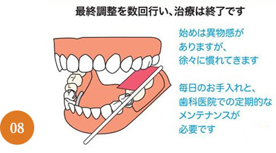 義歯治療の流れ