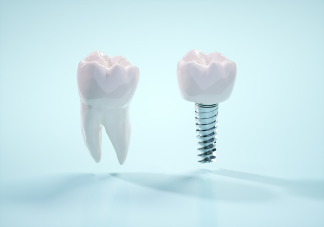 benefits-of-implants