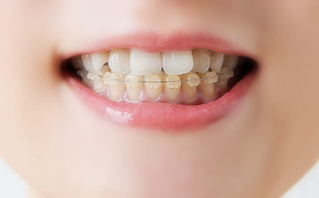 smiling-braces-teeth
