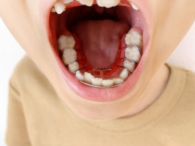 子供の矯正歯科治療