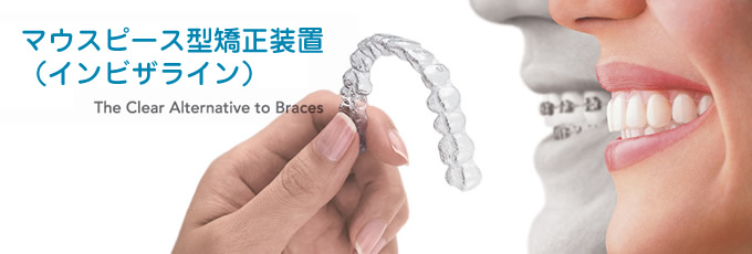 invisalign_1