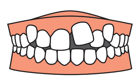 teeth-correction1