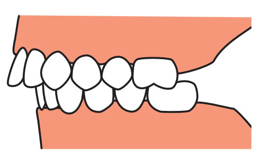 teeth-correction2