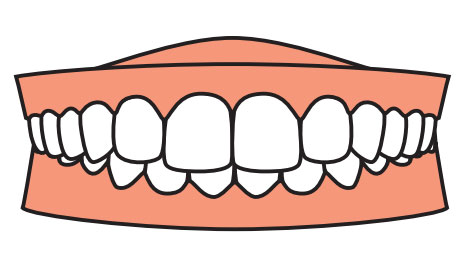 teeth-correction3