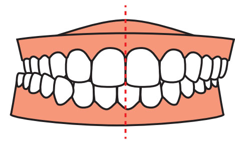 teeth-correction4