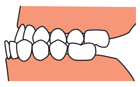 teeth-correction6